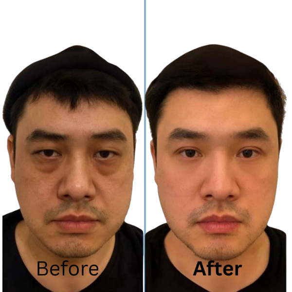 Trifecta Eyebag Treatment