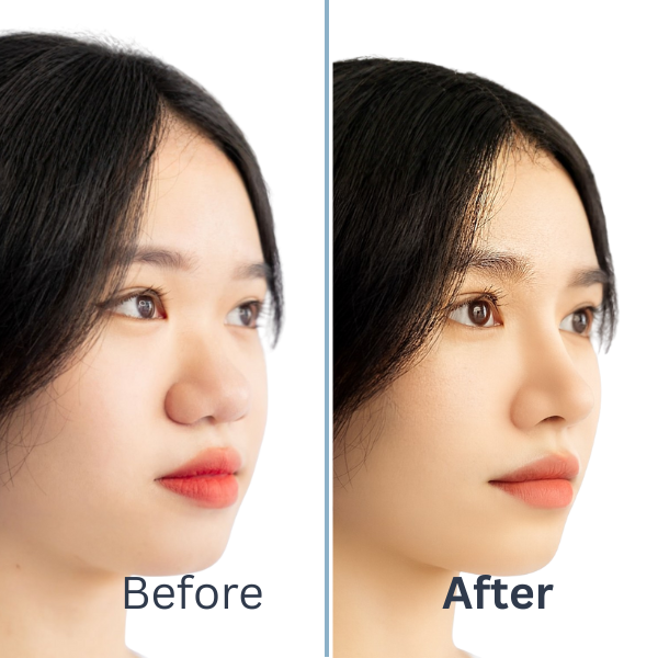 Signature Nose Reshape